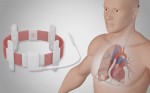 Lần đầu tiên một bệnh nhân được cấy ghép tim nhân tạo sạc không dây